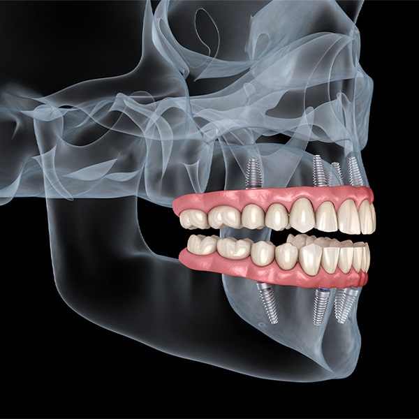 Full mouth reconstruction new