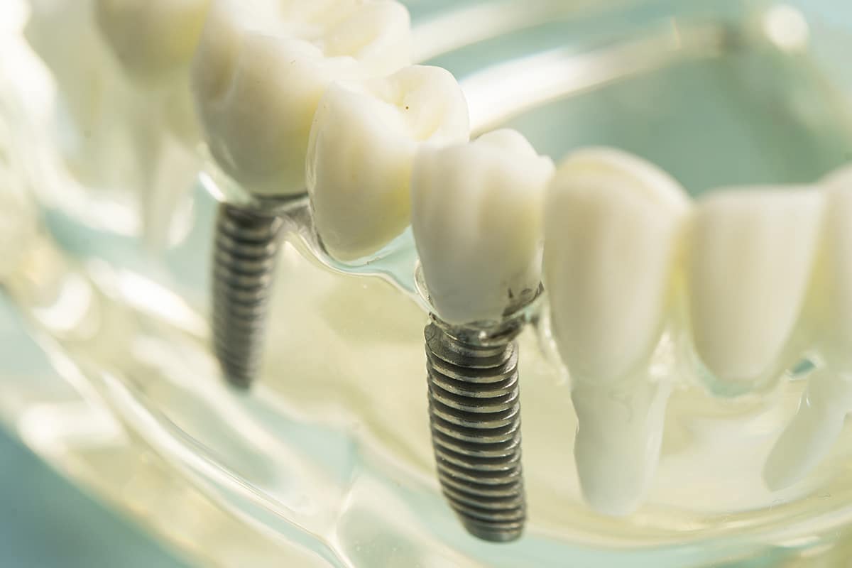 The latest in prosthodontics tech thats changing smiles blog
